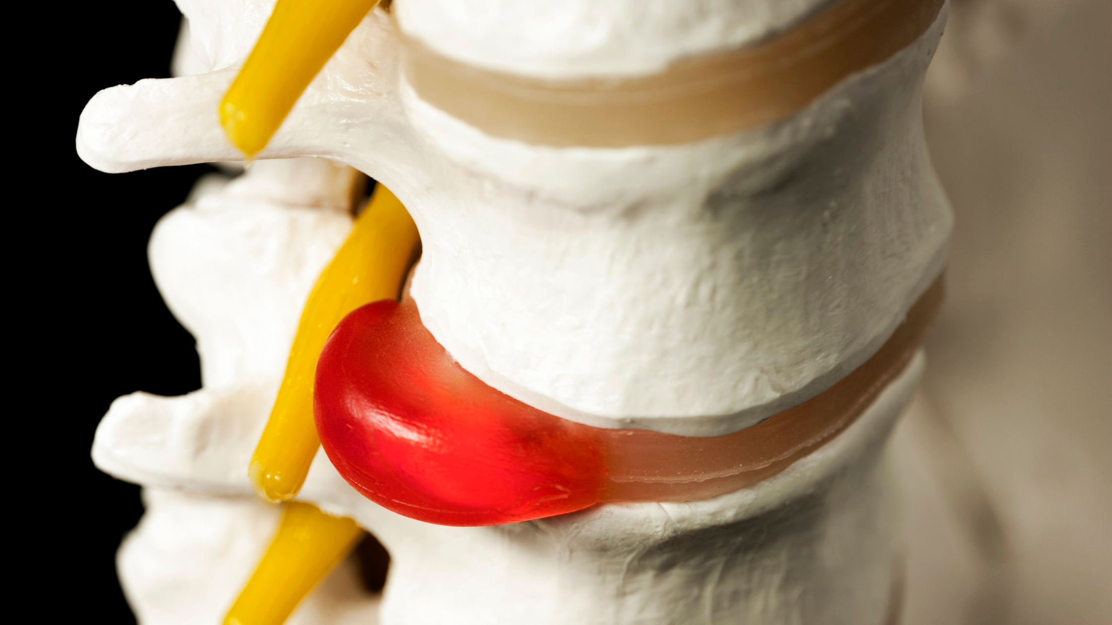 bulging or herniated discs