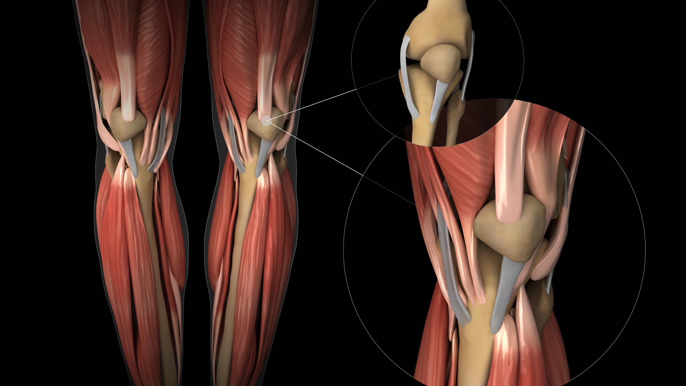 chronic tendon pain